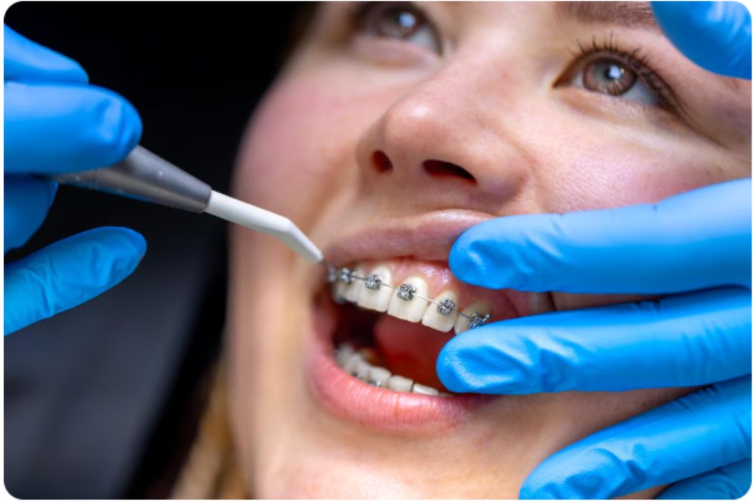 braces and clear aligners which fits your smile